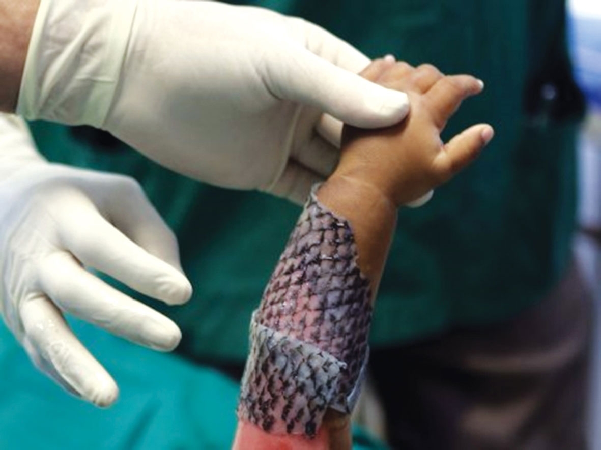 Pielea de pește, folosită în tratamentul arsurilor